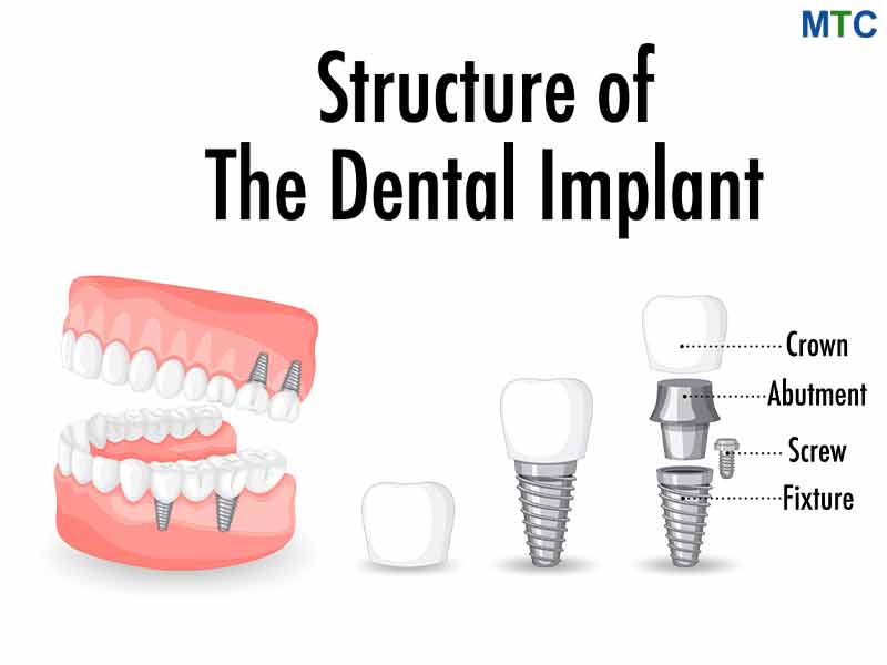 Dental Implant Structure
