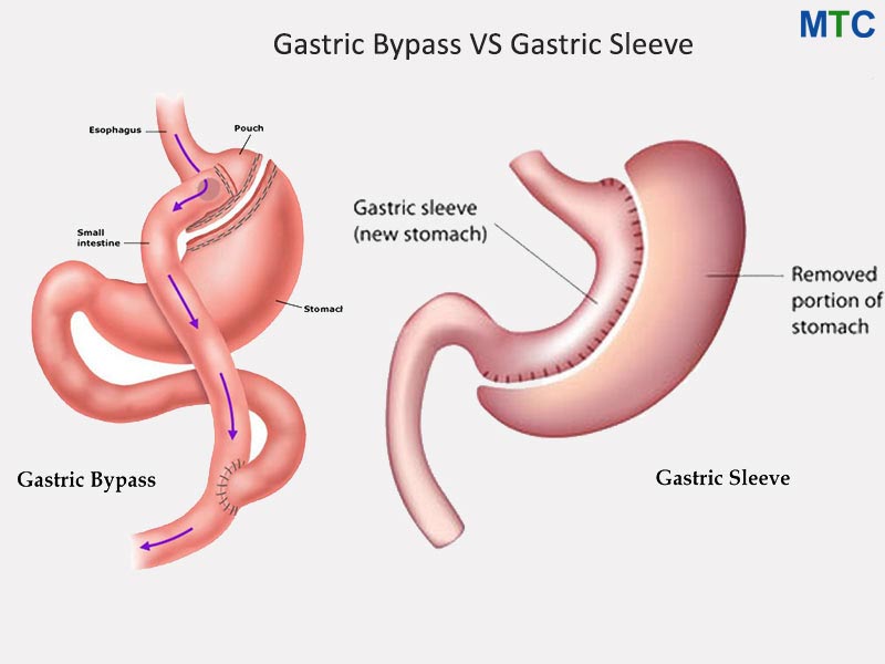 Gastric Bypass Vs Gastric Sleeve