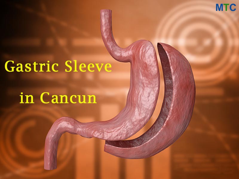 Gastric sleeve surgery in Cancun, Mexico