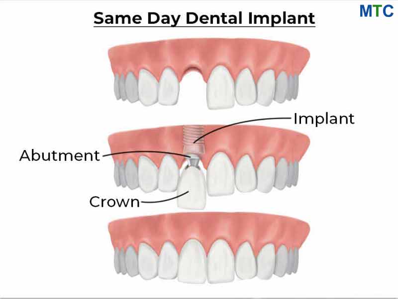 Same Day Dental Implant