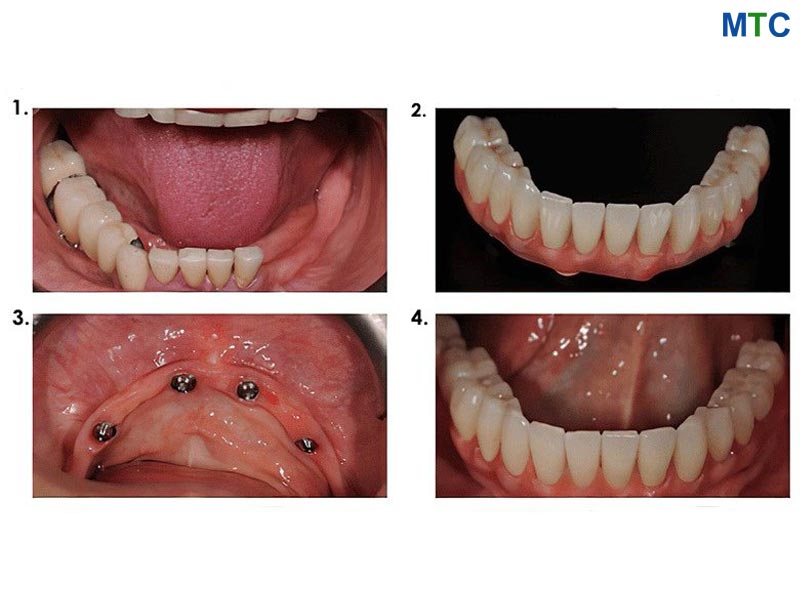 All on Four Implant-Supported Dentures