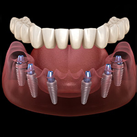 All on 6 dental implants in Costa Rica