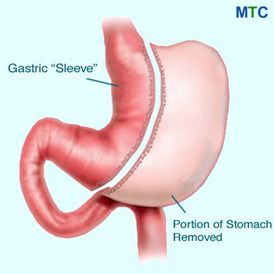 Gastric Sleeve- Weight Loss Surgery in Mexico