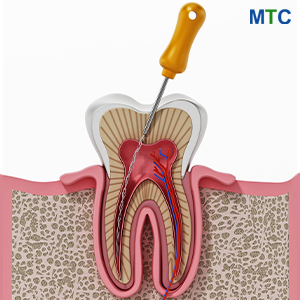 Root Canal Treatment in Cluj Napoca, Romania