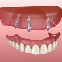All on4 dental implants in Costa Rica