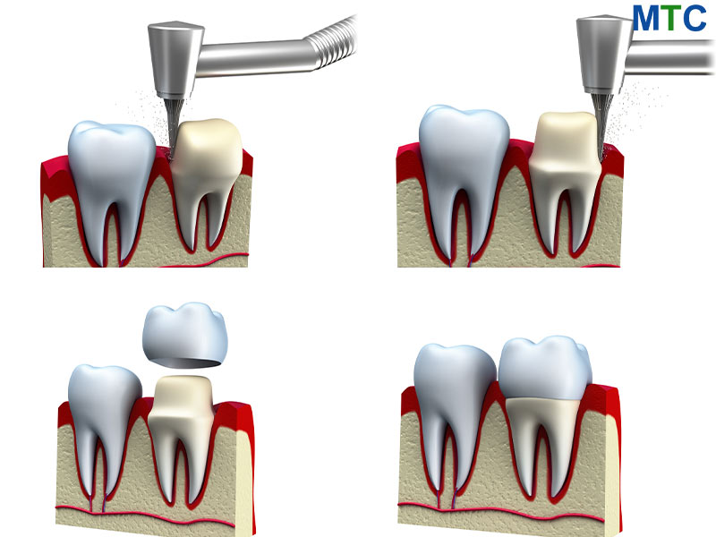Dental crown procedure in Los Algodones