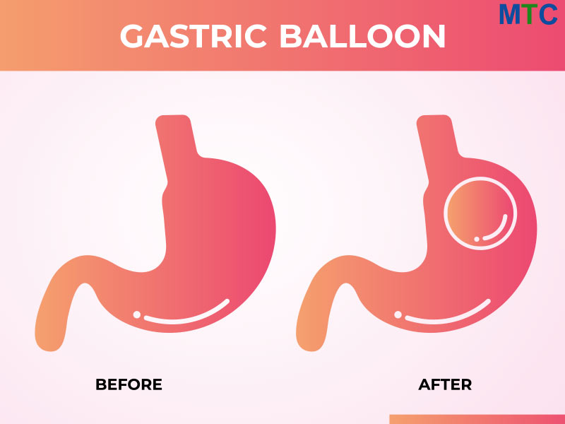 Gastric Balloon in Cancun, Mexico 