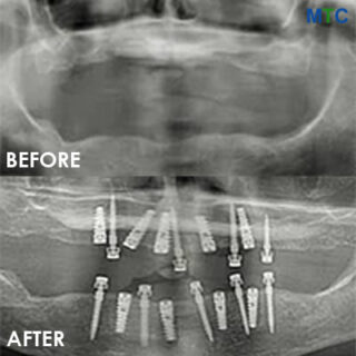 Mini dental implants in Cancun - Before & After