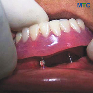 Mini implant denture in Cancun
