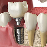 Single dental implant in Costa Rica