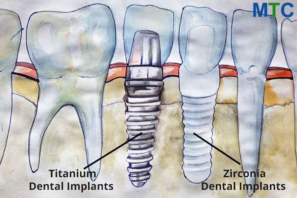 Titanium & Zirconium Dental Implants