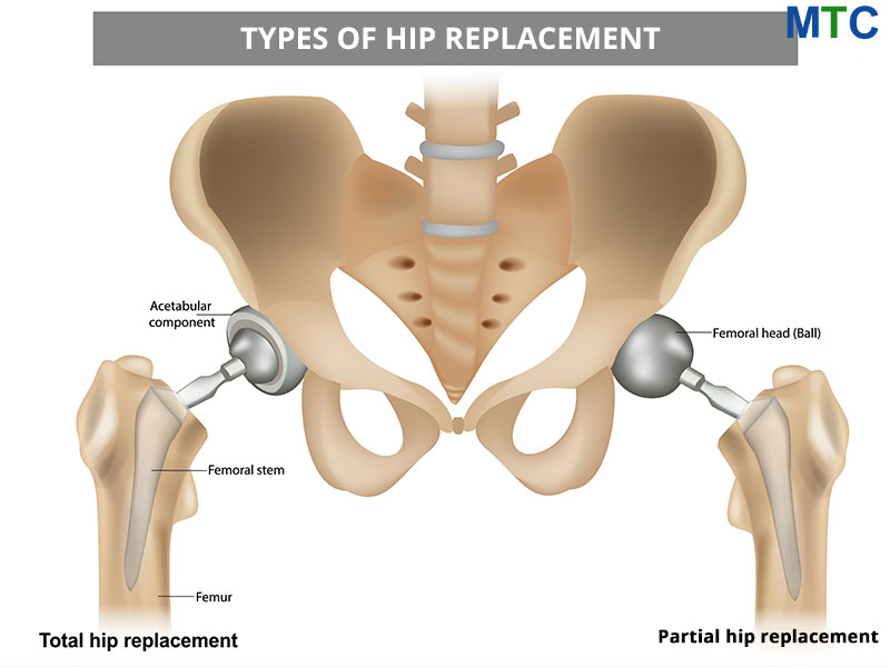 Types of hip replacement in Turkey