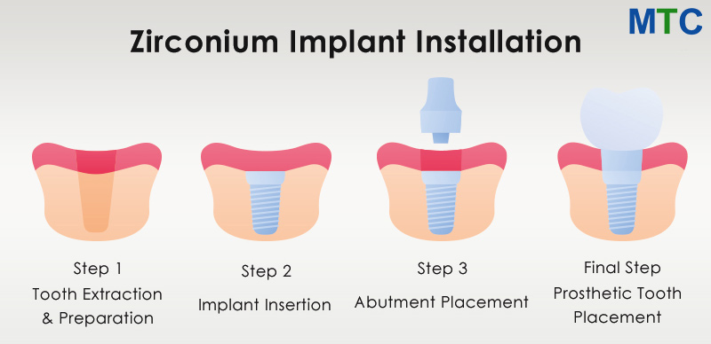 Zirconia Implant Installation Procedure