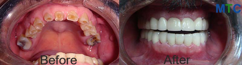 Dental bridge - Before placing (left) & after placing (right)