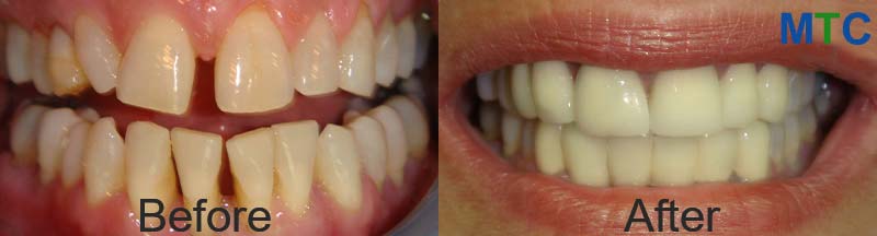 Dental crowns - Before placing (left) & after placing (right)