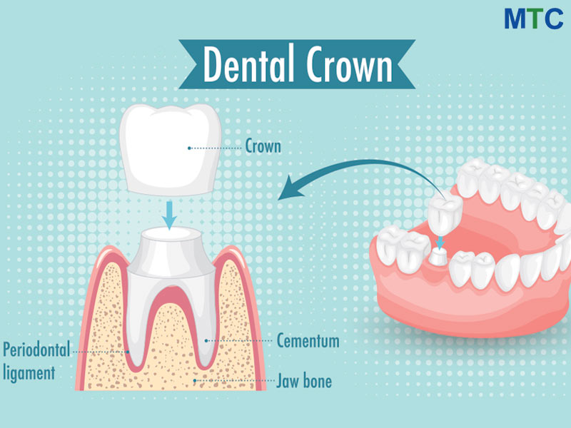 Dental Crown in Cancun