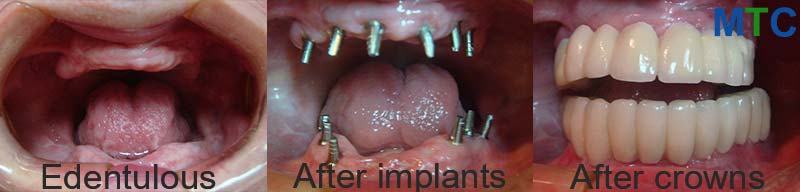 Before dental implants (left); Dental implants before crowns are placed on them (center); After dental implants were placed (Right)