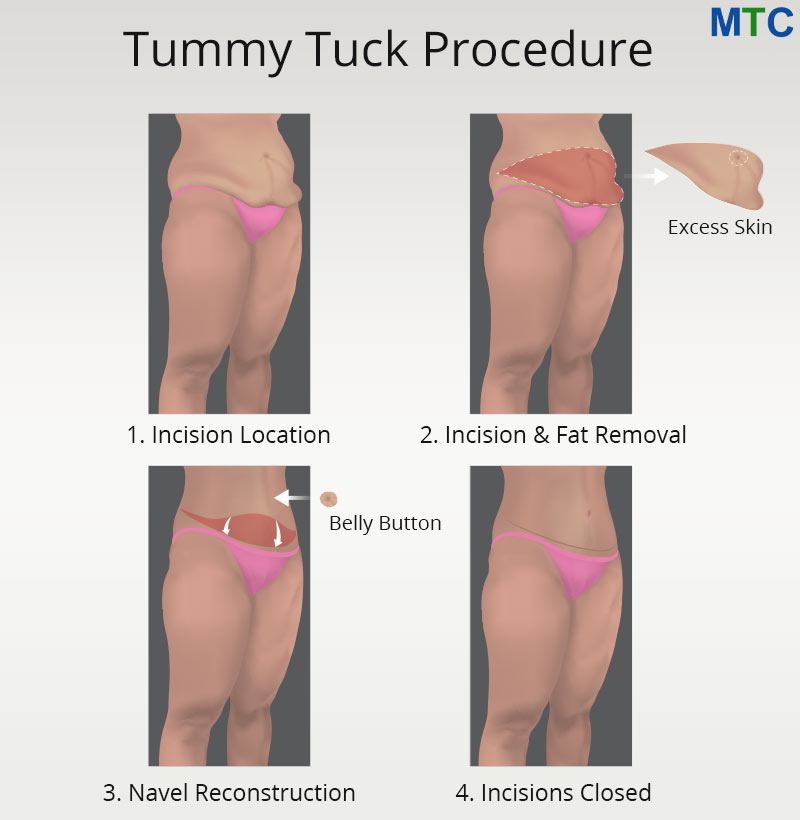 Tummy Tuck Procedure 