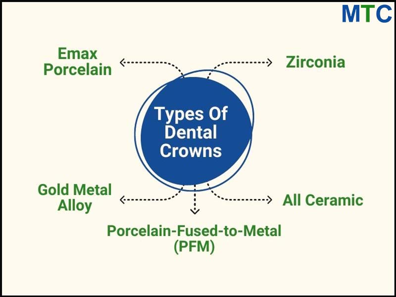 Types of Dental Crowns in Cancun