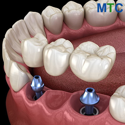 implant supported crown bridge