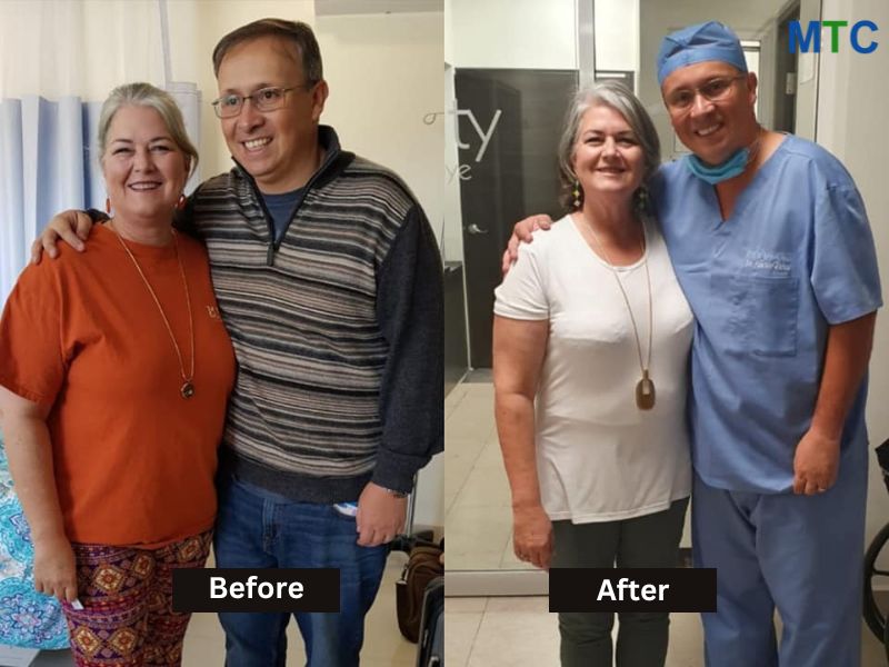 Bariatric Surgery Before and After