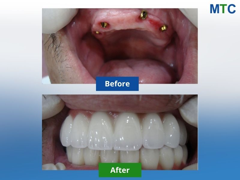 All on 4 implants in vietnam before and after