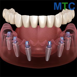 All on 6 dental implants in Vietnam