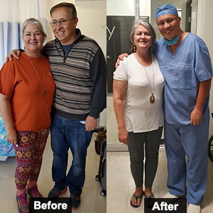 Before and after bariatric surgery by Dr. Hector Perez