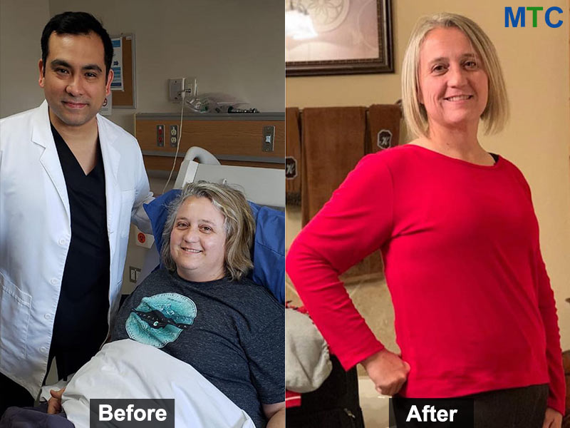 Before & After: Bariatric Surgery in Tijuana