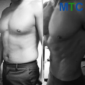 Before & After Liposuction in Male