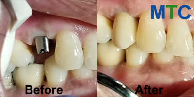 Dental Implants - Before & After