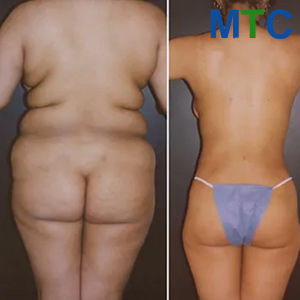 Before & After: Liposuction in Female