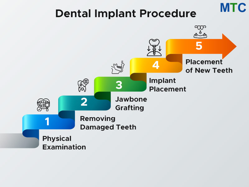 Dental Implant Procedure 