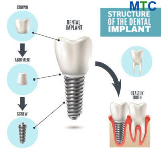 Structure of a dental implant
