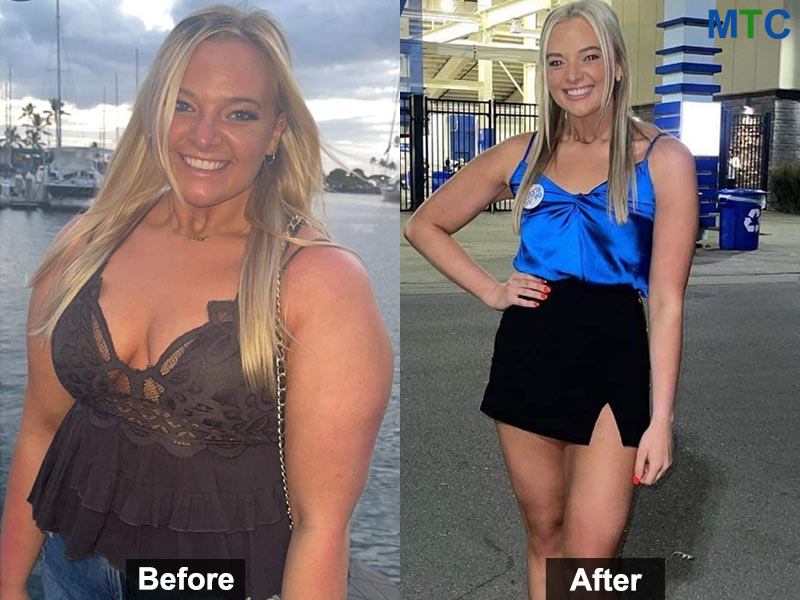 Before & After Gastric sleeve in Mexico