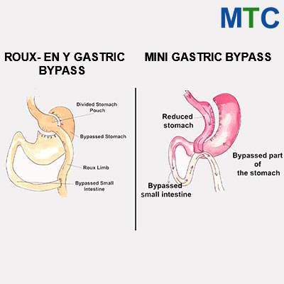 RYGB Vs Gastric Bypass