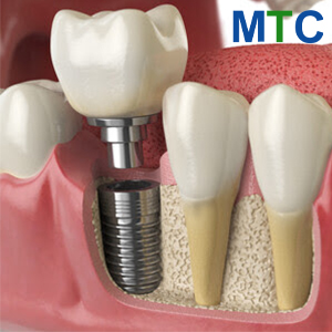 Same-Day Dental Implants 