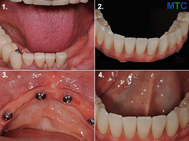 All on 4 Dental Implants Process