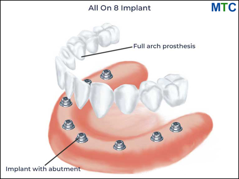 All on 8 Dental Implants