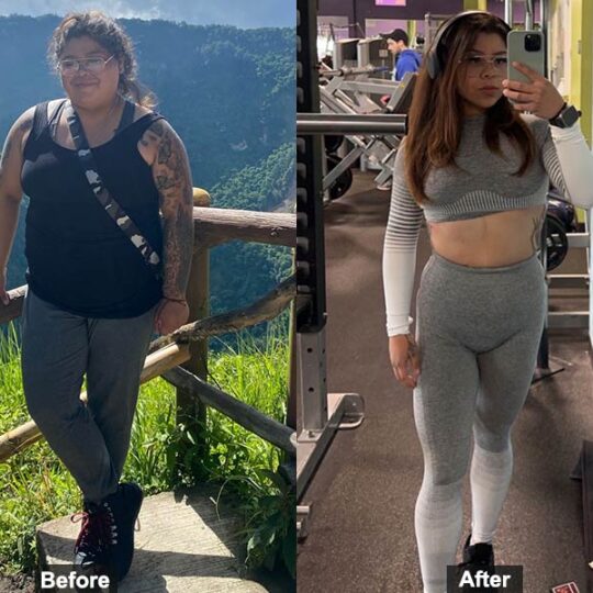 Before After Bariatric Surgery in Tijuana