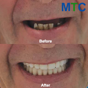 Before & After: All-on-4 Dental Implants Abroad