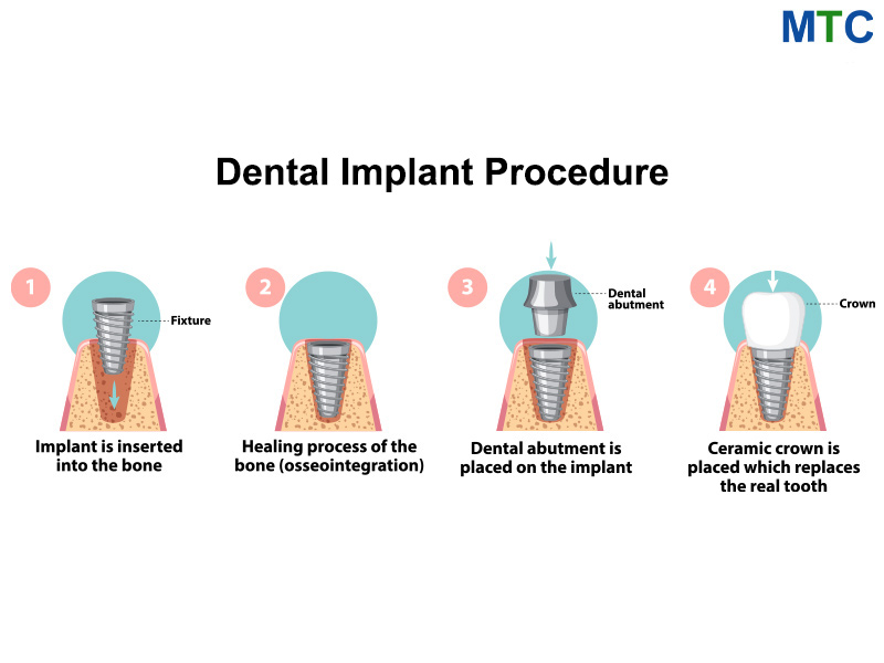 Procedure of Dental Implants in Croatia
