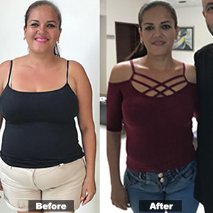 Sleeve Gastrectomy in Puerto Vallarta - Before & after