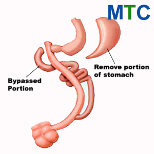Duodenal | Type of WLS in Mexico