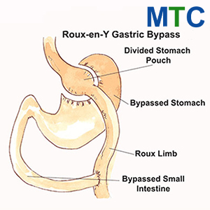 Gastric bypass in Istanbul