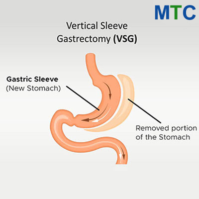 Gastric sleeve in Istanbul