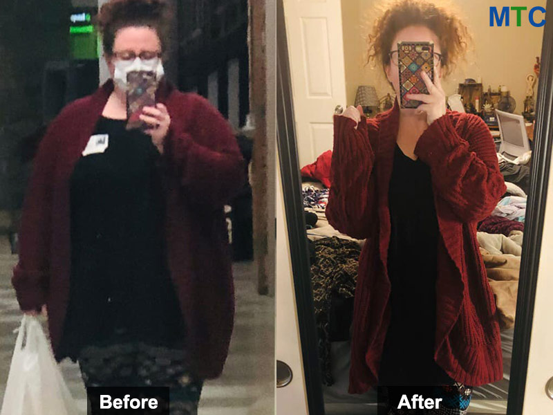 Janelle Woodburn - before and after her gastric sleeve surgery in Tijuana