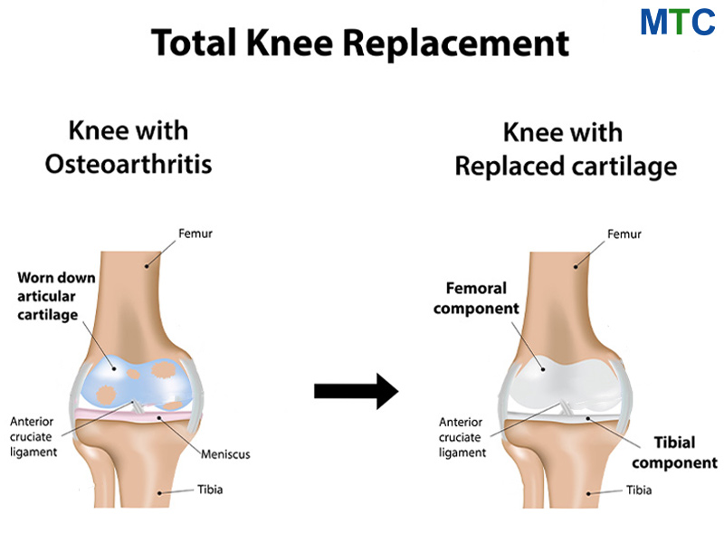 Total Knee Replacement in Istanbul, Turkey