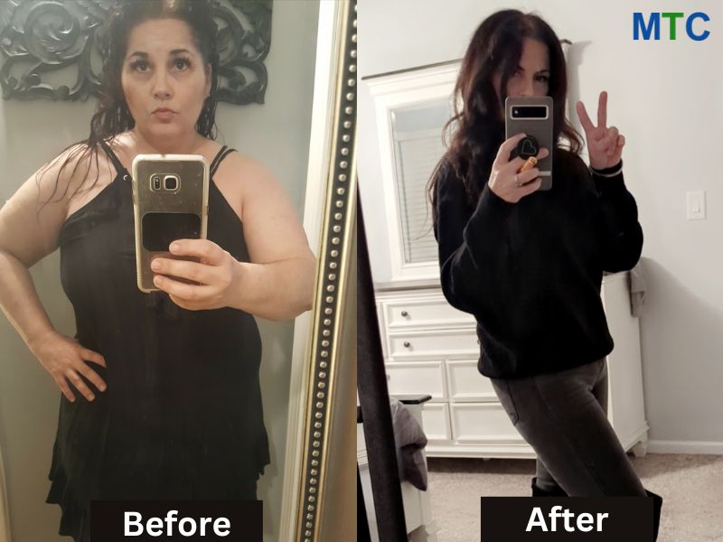 Michelle Gasca | Before & After Gastric Sleeve in Tijuana
