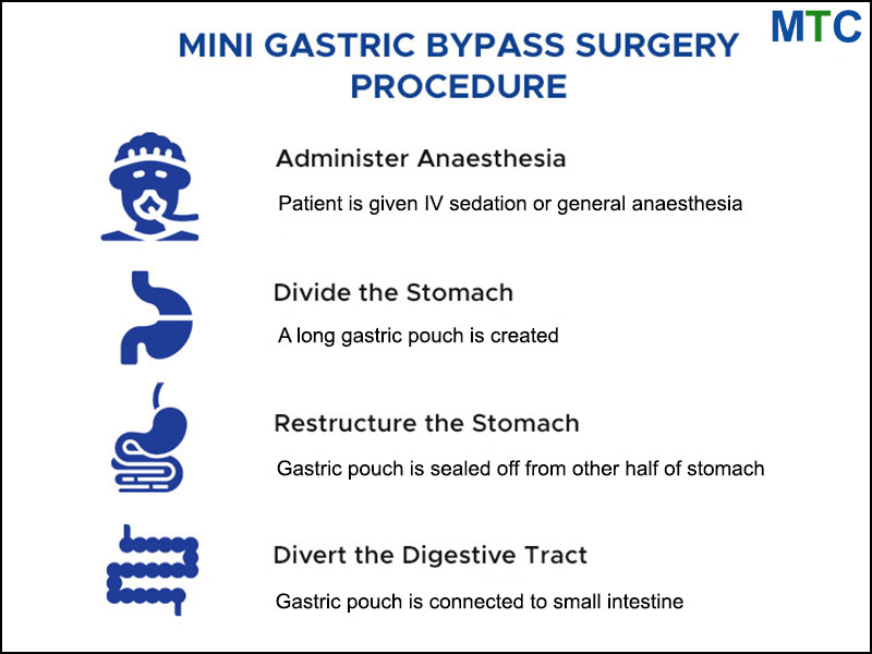 Mini Gastric Bypass Surgery Procedure